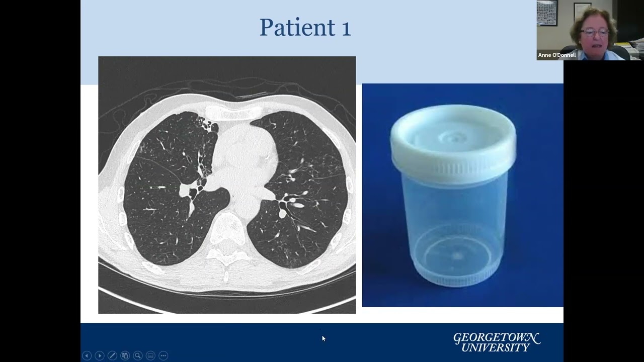 Update on Bronchiectasis Treatments Including new Investigational Therapies