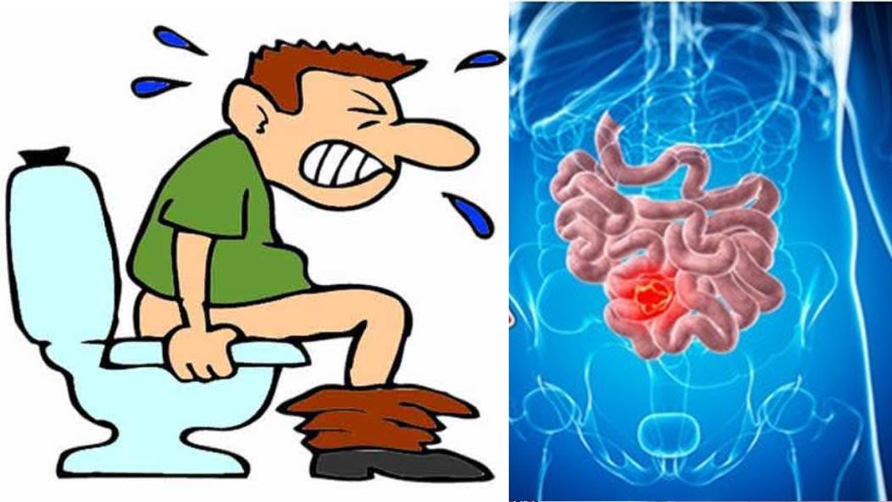 Impamvu 8 zitera kwituma impatwe (constipation) ndetse n' umuti wabyo n' uko wabyirinda|| Muganga