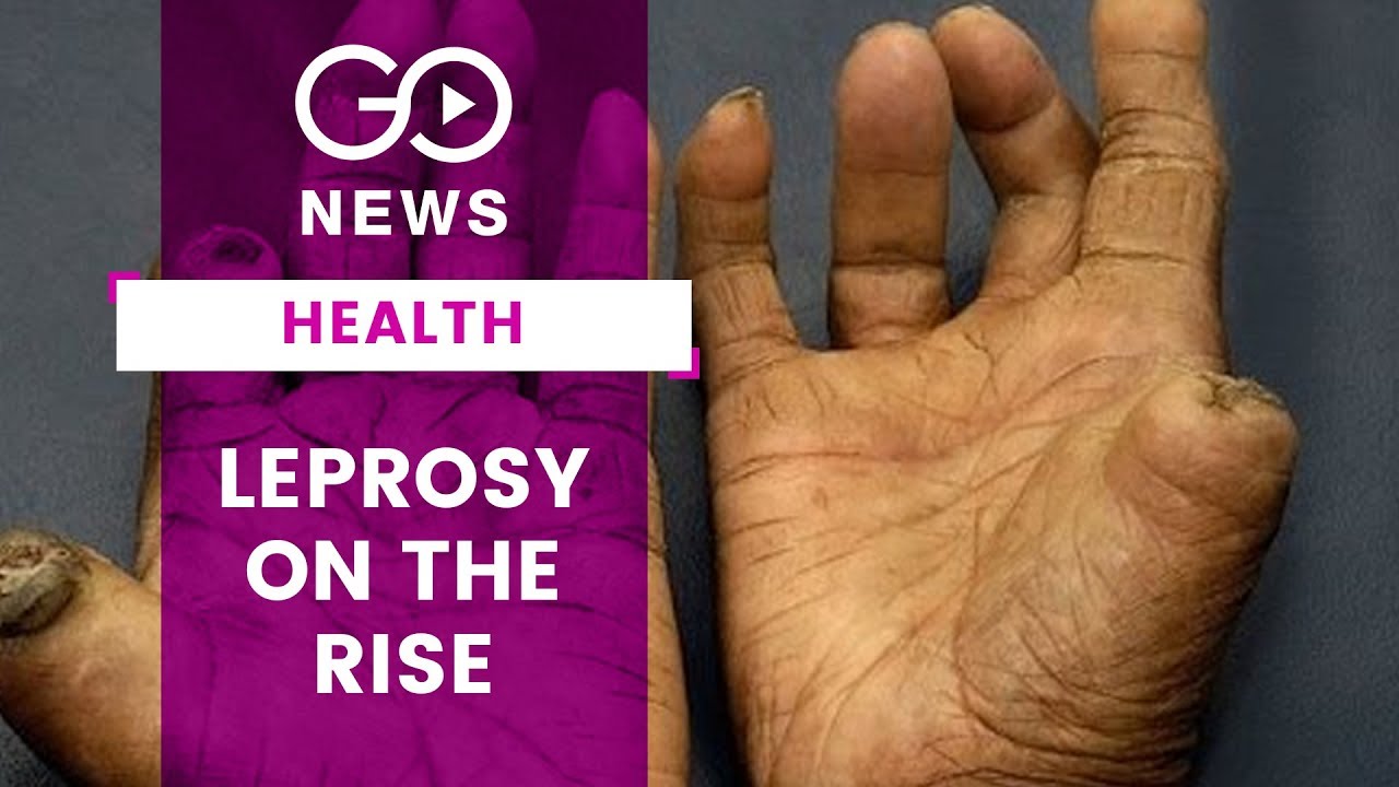 Leprosy On The Rise