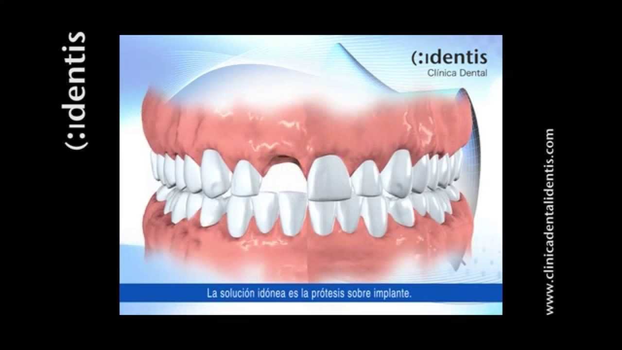 CLÍNICA DENTAL IDENTIS EL IMPLANTE