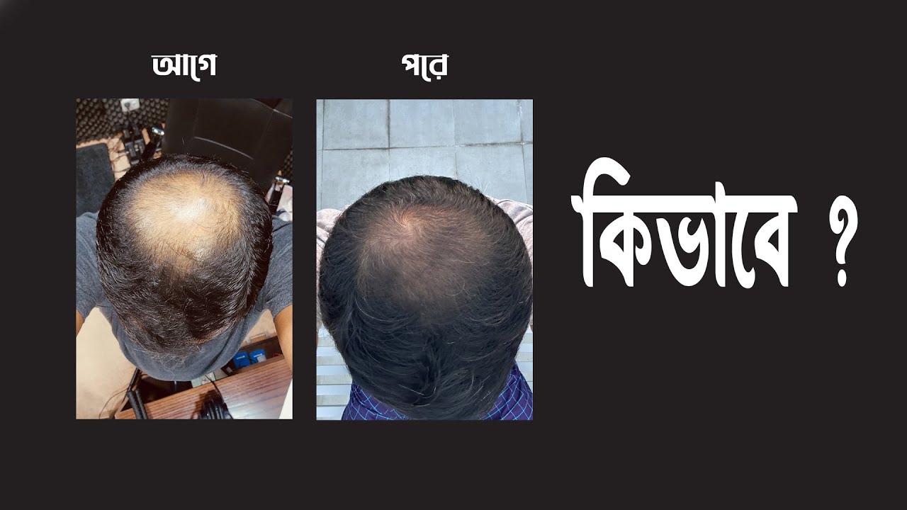 চুলের সমস্যার একমাত্র সমাধান ! FDA এপ্রুভ !