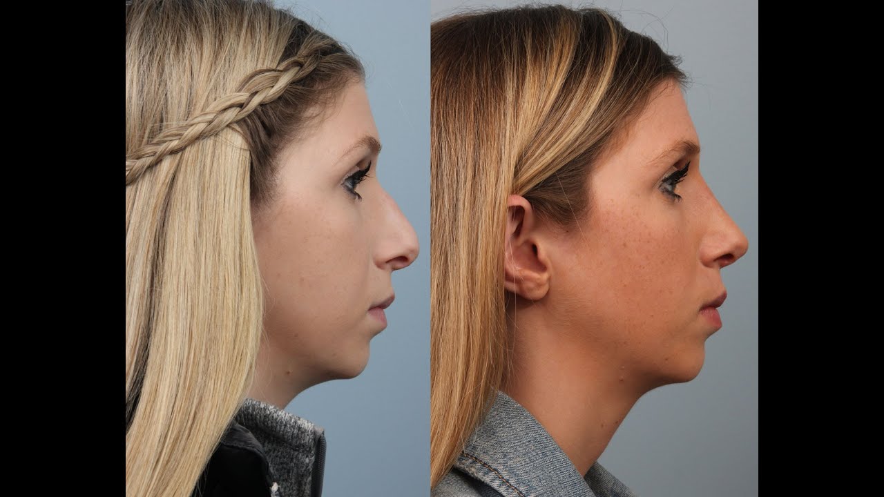 Fireside Chats with Dr. Edwin Williams: What is a Rhinoplasty Specialist?