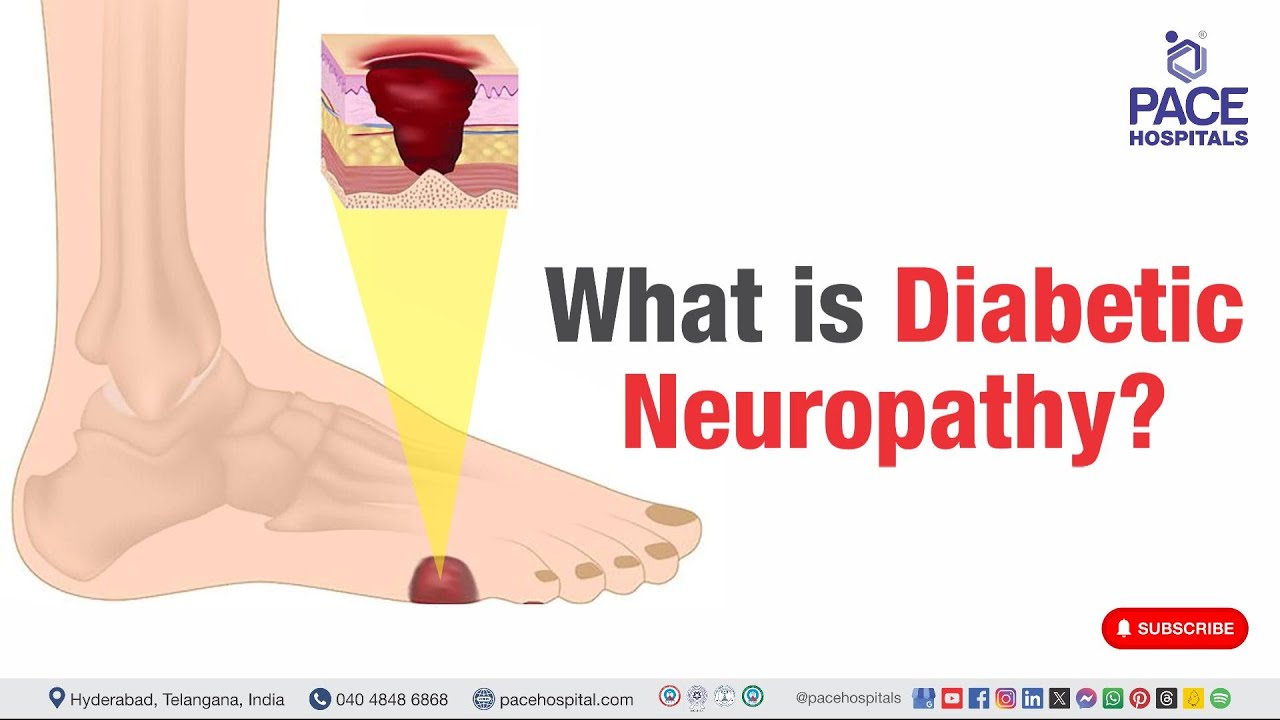 Diabetic Neuropathy | What is Diabetic Neuropathy? | #diabeticneuropathy