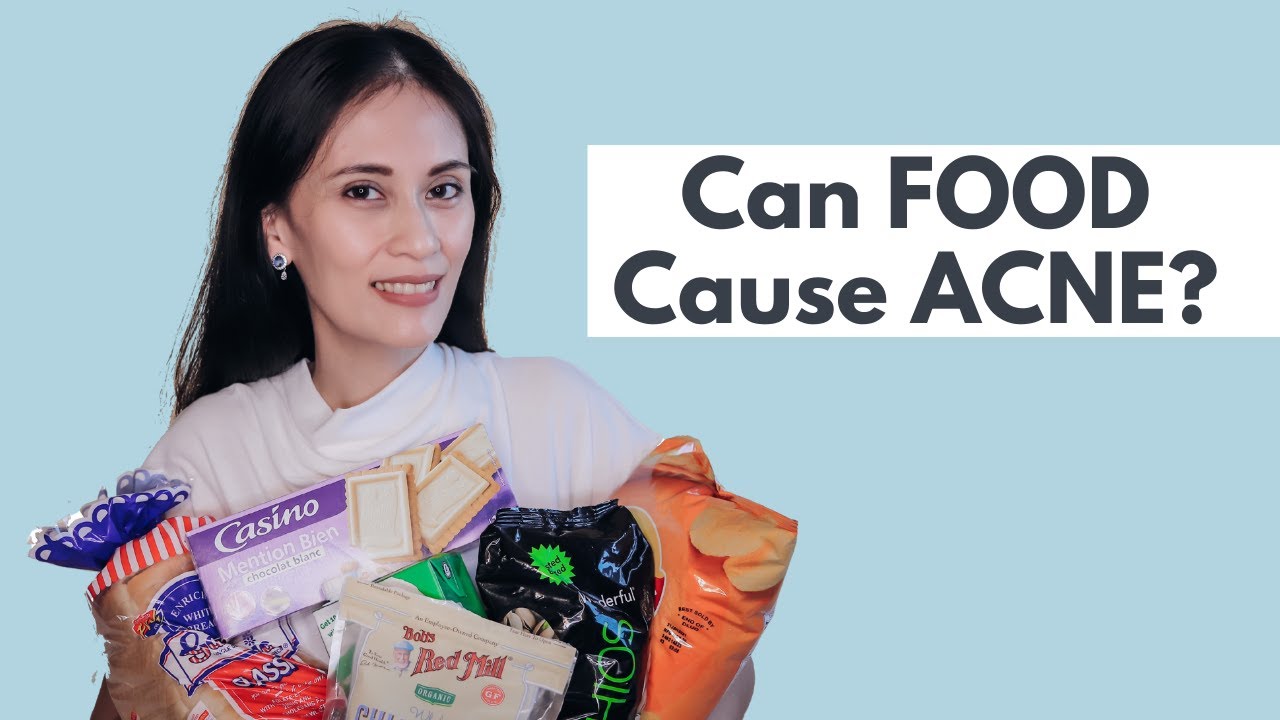 Does food cause ACNE? | Dr Gaile Robredo-Vitas