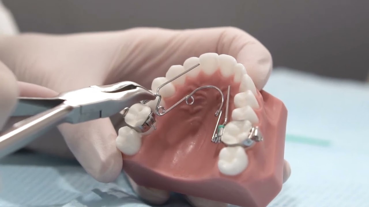 Solución urgencia de quad helix o expansor del paladar