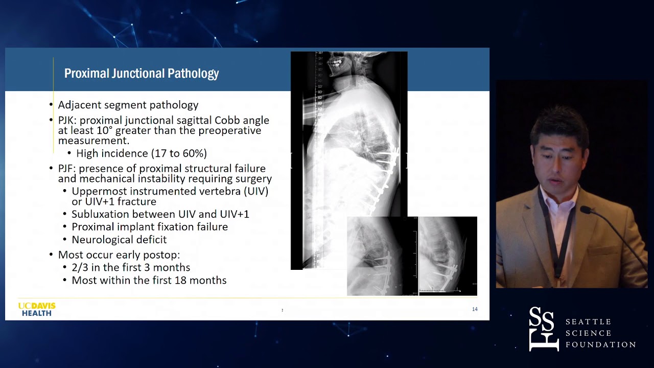 Adult Spinal Deformity Surgery  Complication Prevention   Kee D  Kim, MD