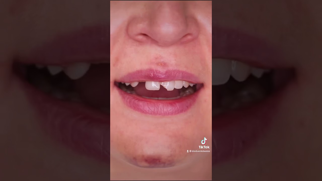 3 Raz&otilde;es para colocar Facetas Dent&aacute;rias 🧐
