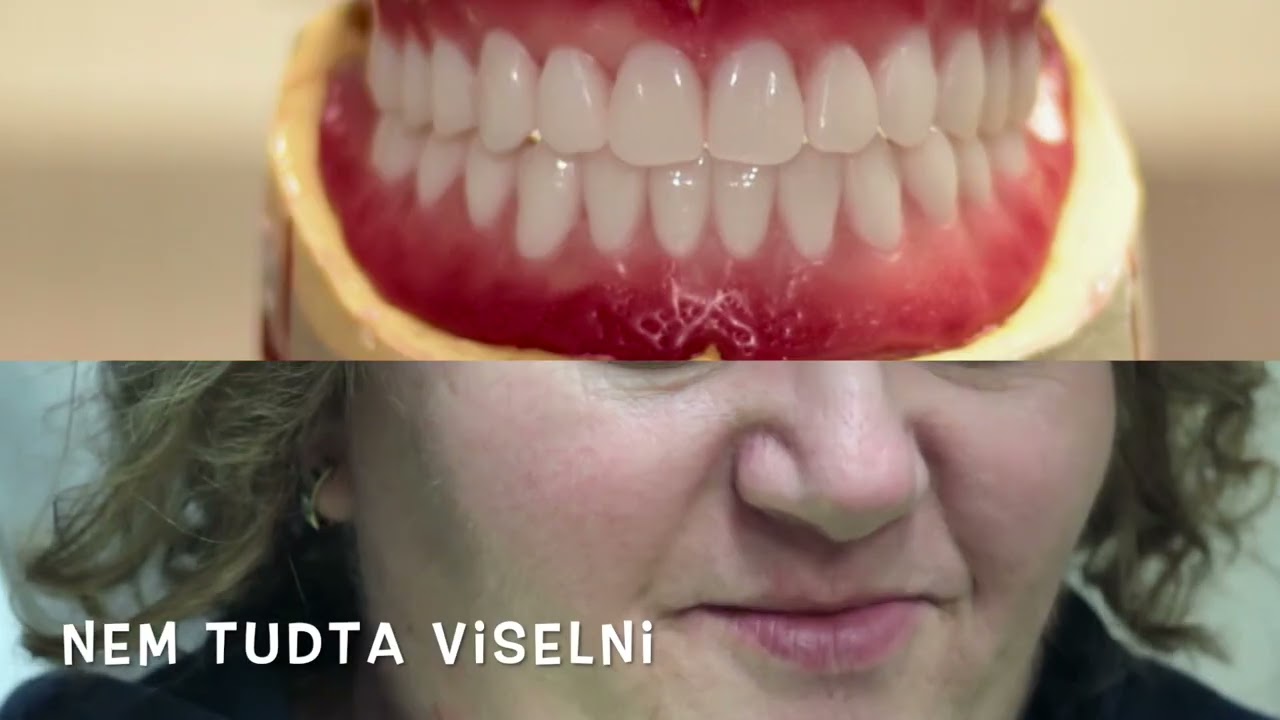BioFIX teljes kivehető protézis: a STABIL ALSÓ fogsor!