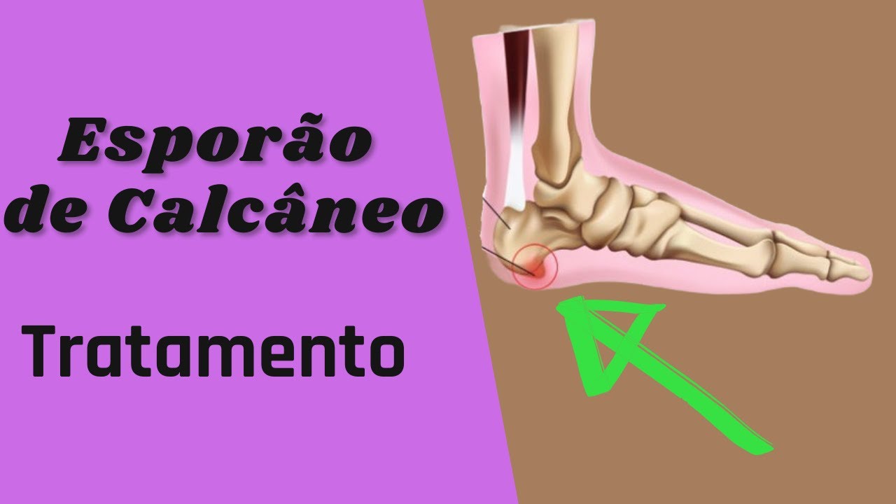Esporão de Calcâneo  - Tratamento com Acupuntura Distal