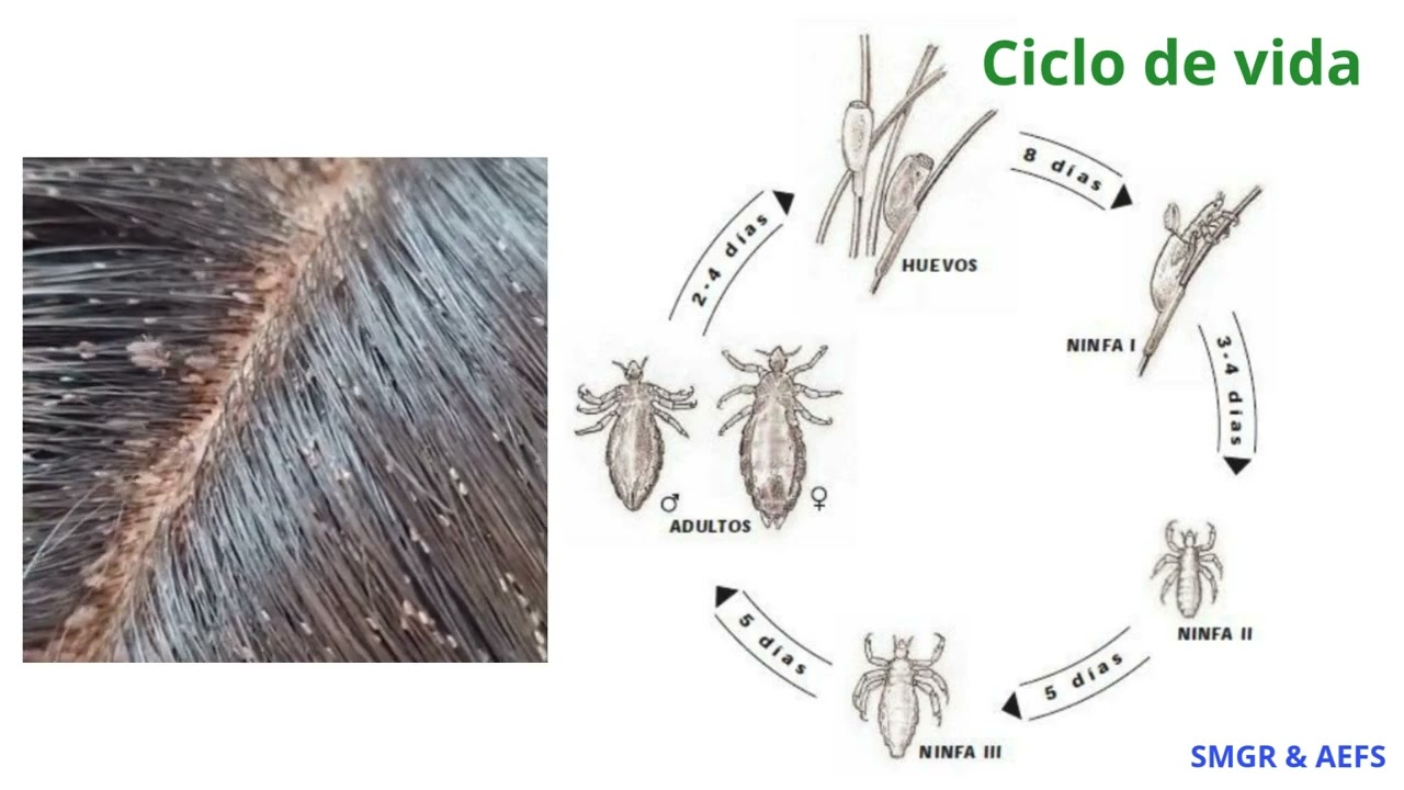 ¿Piojos? Conoce la pediculosis