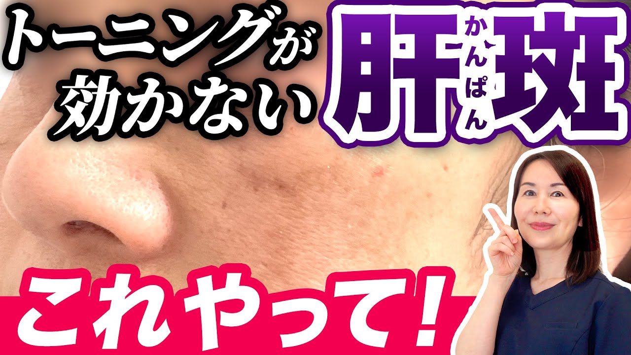 【30代40代必見】肝斑・色素沈着に効くケミカルピーリングって？
