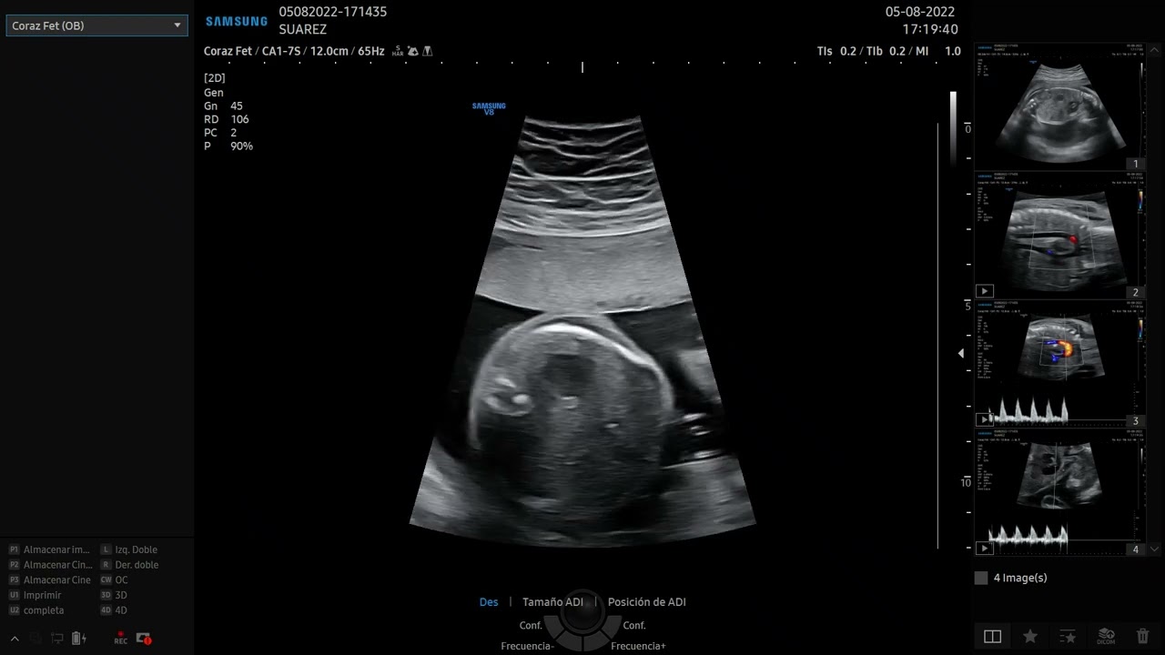 V8 de Samsung. Ecografía de DEMOSTRACIÓN en Obstetricia.
