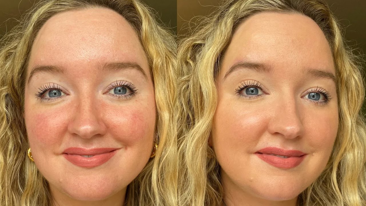 Oxygenetix Foundation and Rosacea