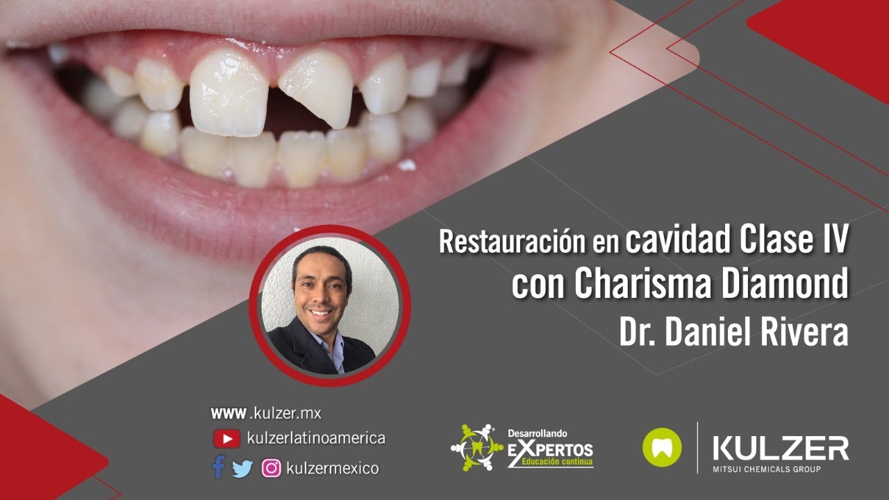 Desarrollando eXpertos - Restauración en  cavidad clase IV con resina Charisma Diamond
