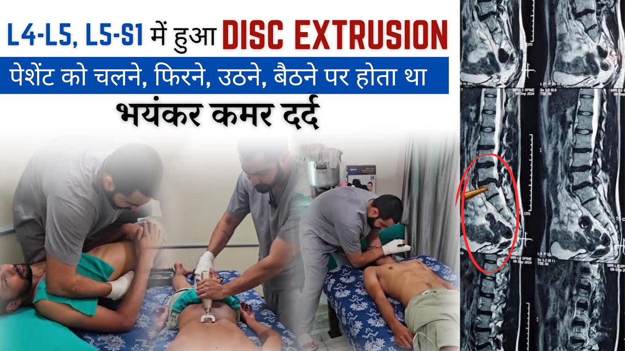 L4-L5 L5-S1 में हुआ DISC EXTRUSION पेशेंट को चलने फिरने उठने बैठने पर होता था  भयंकर कमर दर्द