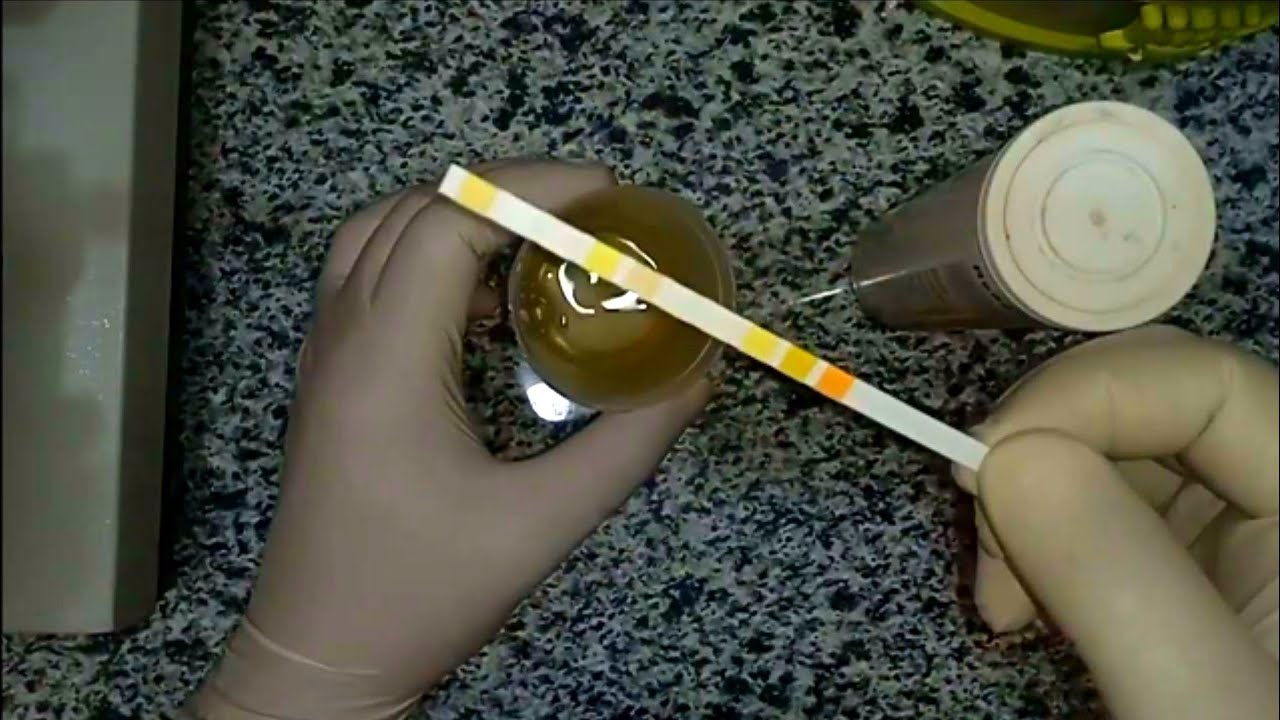 تحليل البول الكامل(Urine examination)خطوة بخطوة مع كتابة التقرير وقراءة النتيجة
