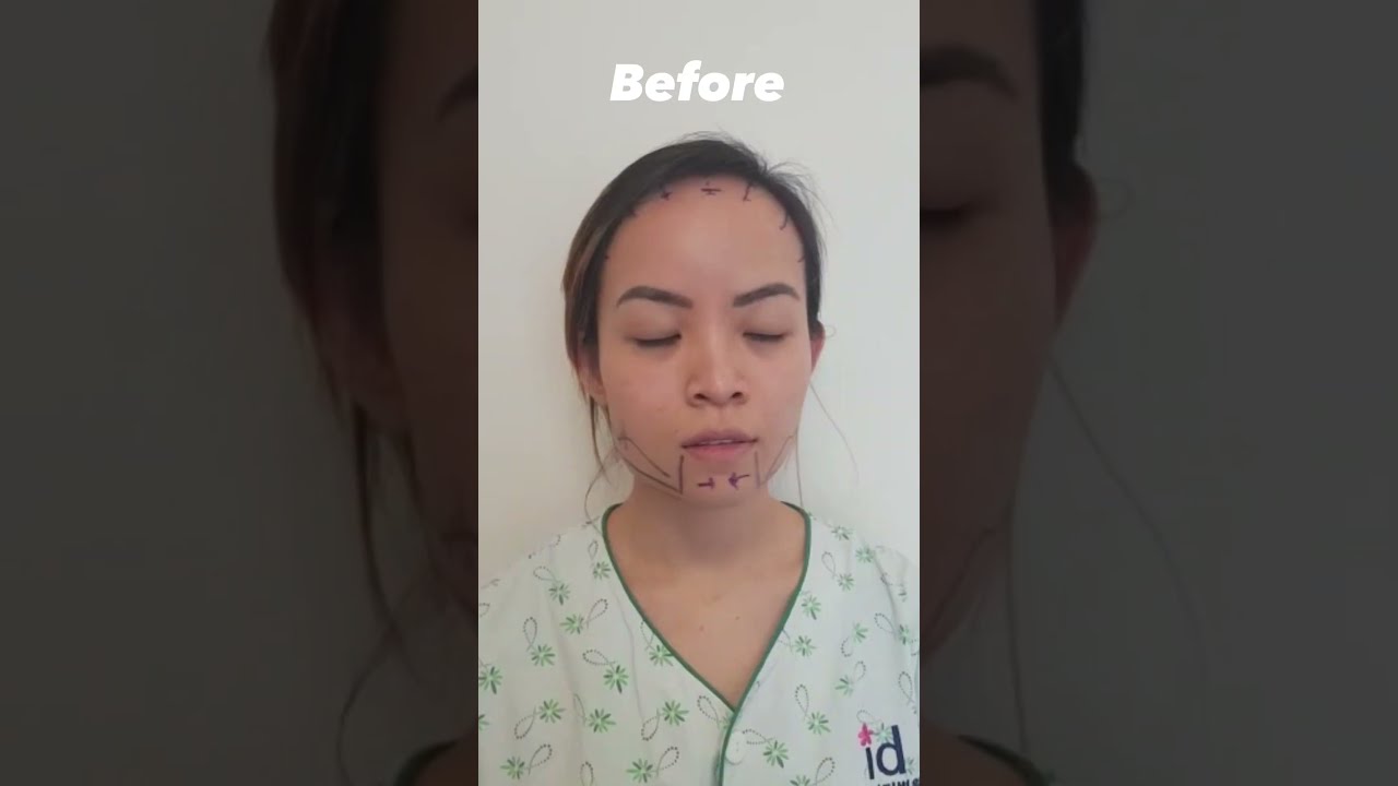 Full Face Transformation