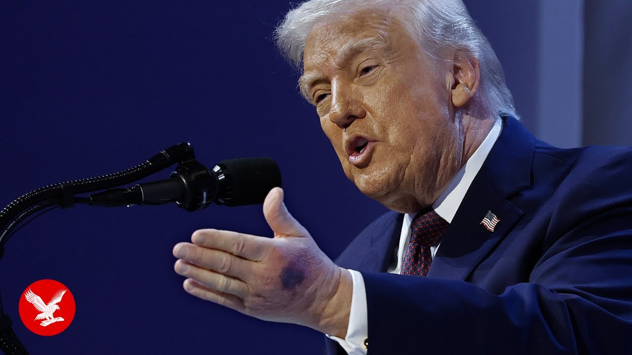 Trump links new hand bruise to his aspirin consumption
