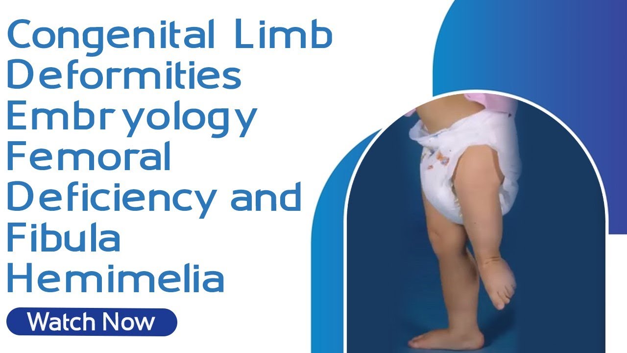 Congenital Limb Deformities | Embryology | Femoral Deficiency and Fibula Hemimelia