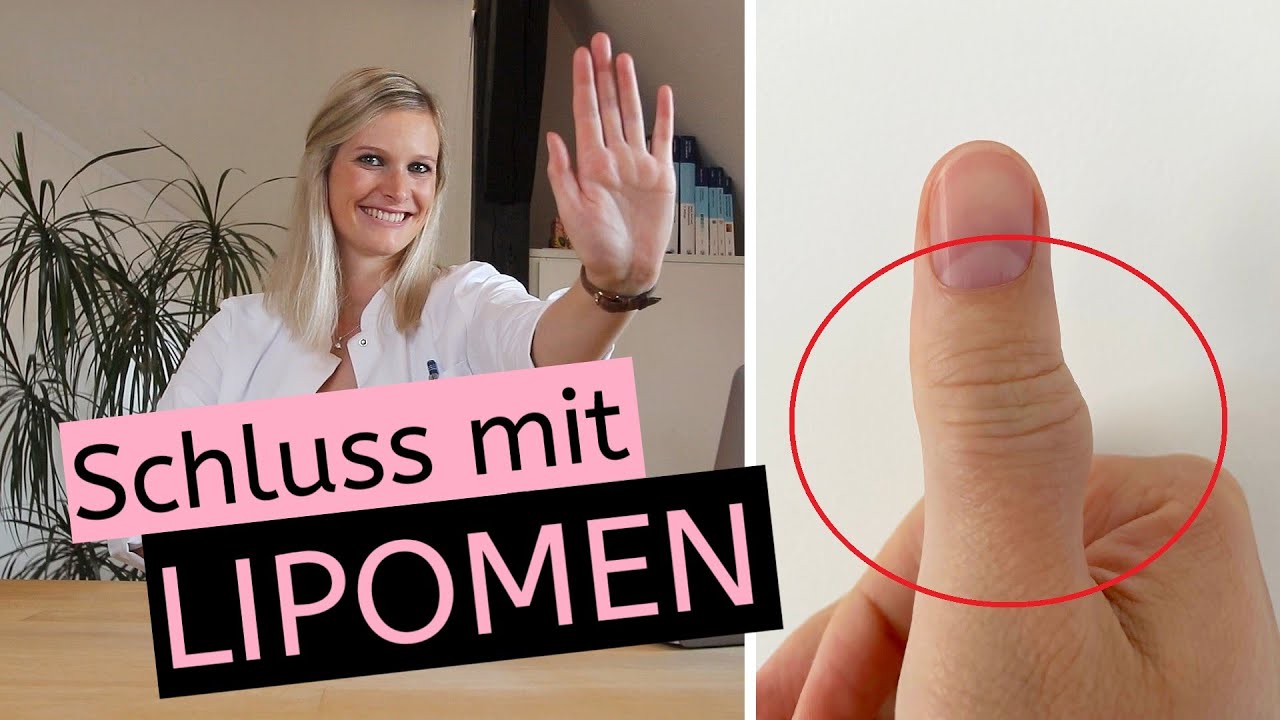 Schluss mit Lipomen bzw. Fettgeschwulsten | Derma-Quick-Tipp | Entfernung | OP | Lipolyse