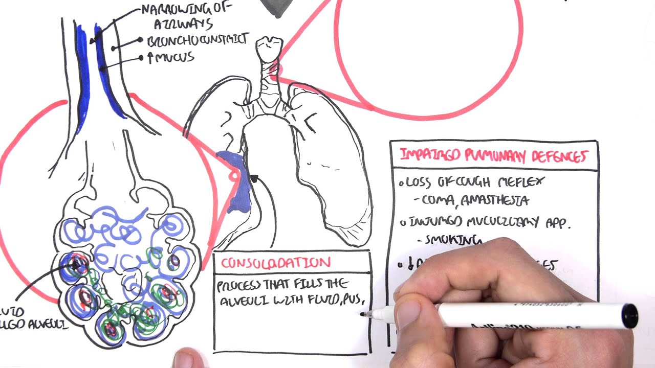 PART I - Pneumonia (Overview, Lobar and Bronchopneumonia)