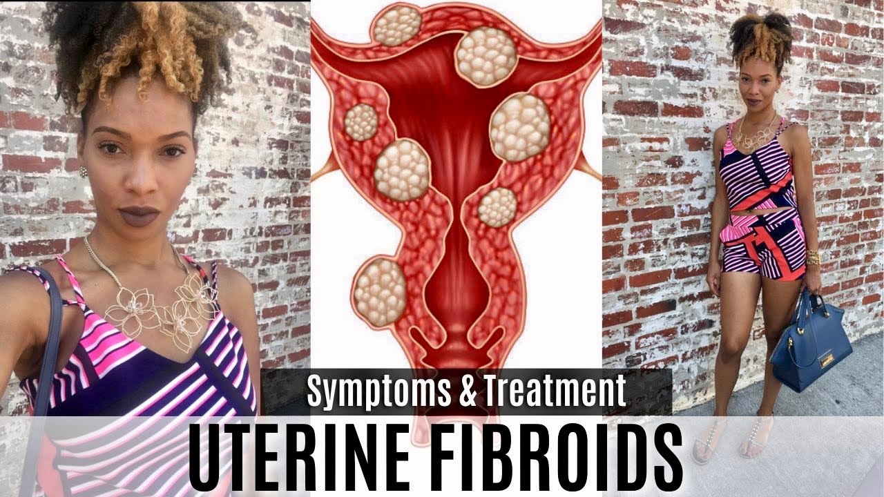 Uterine Fibroids, Symptoms, and Treatment/Surgery Options: Part 1/3