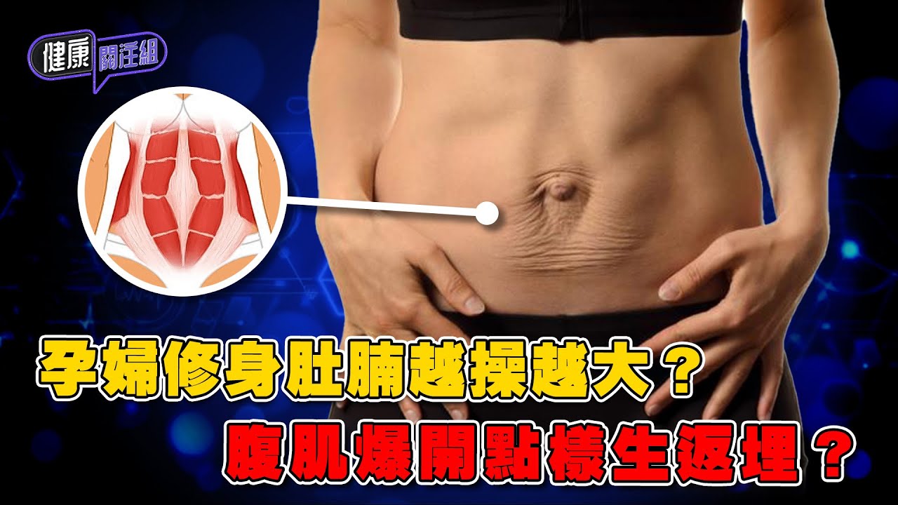 孕婦修身肚腩越操越大？腹肌爆開點樣生返埋？｜ 健康關注組 ｜ EP509 ｜ 腹直肌分離 ｜ 孕婦 ｜ 紮肚 ｜ 吳雲甫 ｜ 黃芳雯 ｜ HOY TV 77台