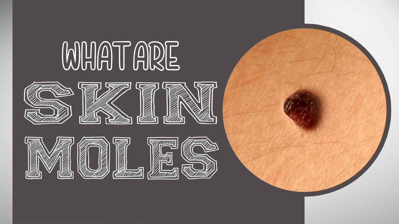 What are Skin Moles?