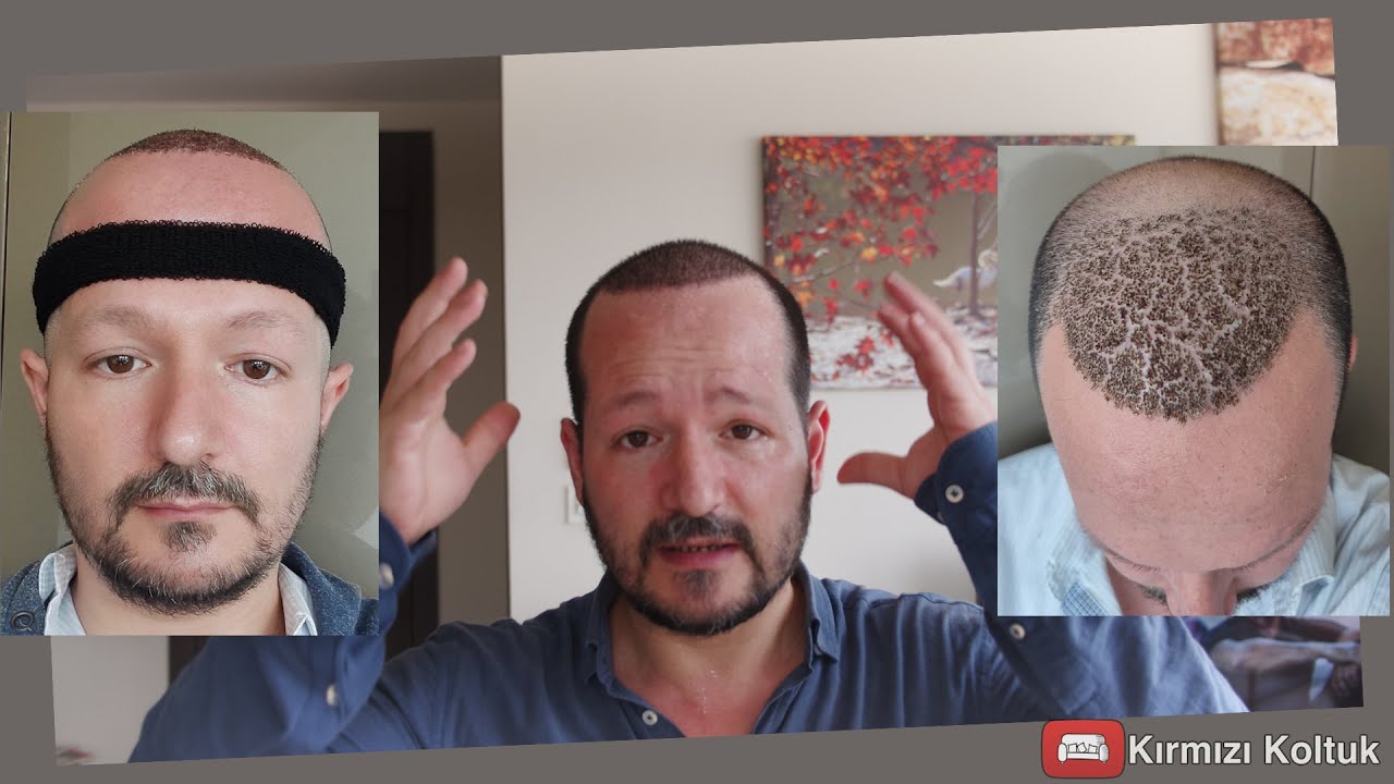 Saç Ekimi Macerası ve Süreci - Gün 22 - Serkan Aygın Klinik - 4200 Greft