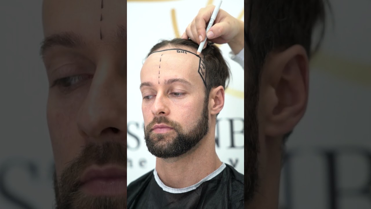 Hair Transplant Journey at Istanbul Care Clinic | Live Procedure from Turkey