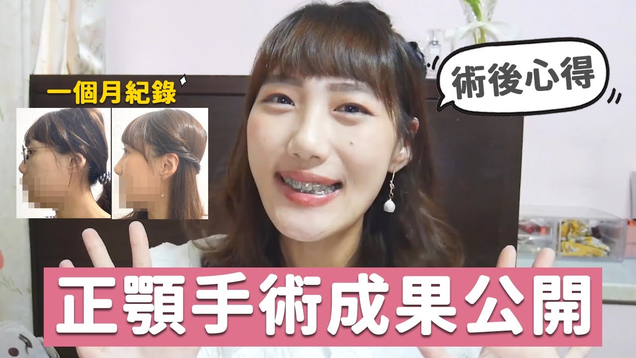 正顎手術成果公開｜一個月紀錄、術後心得分享