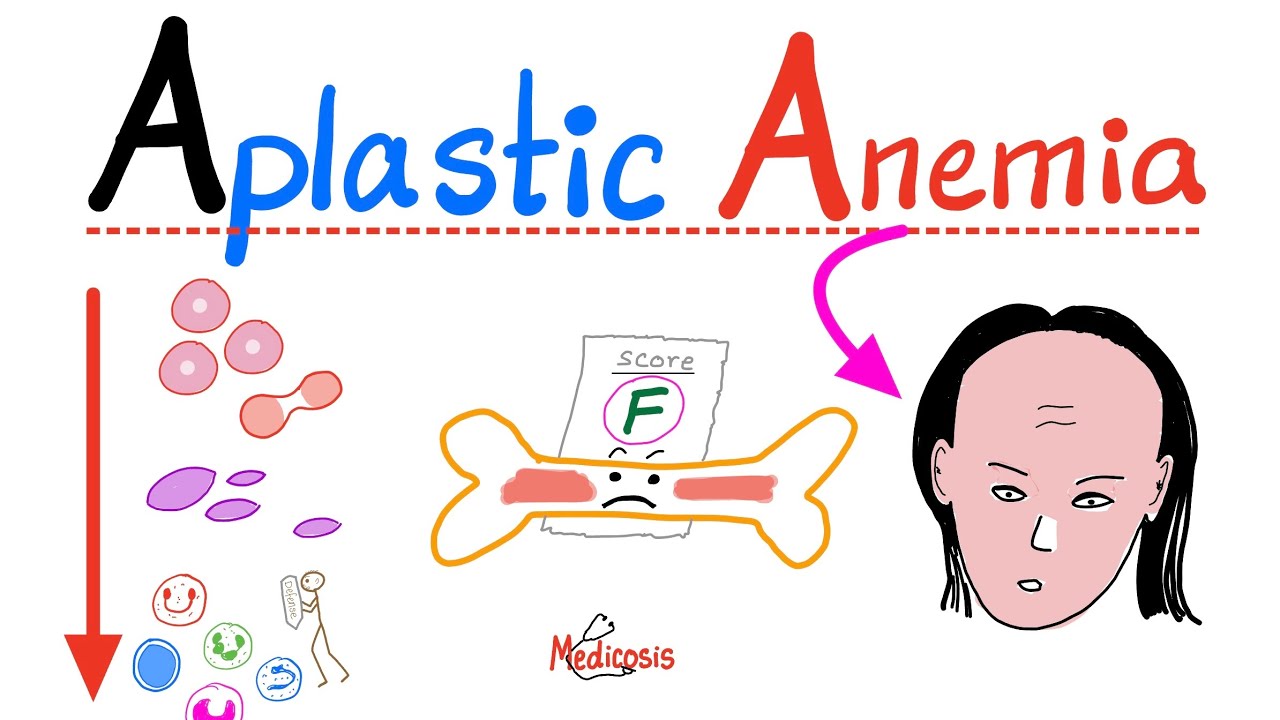 Aplastic Anemia - All you need to know - Definition, Causes, Symptoms, Diagnosis & Treatment