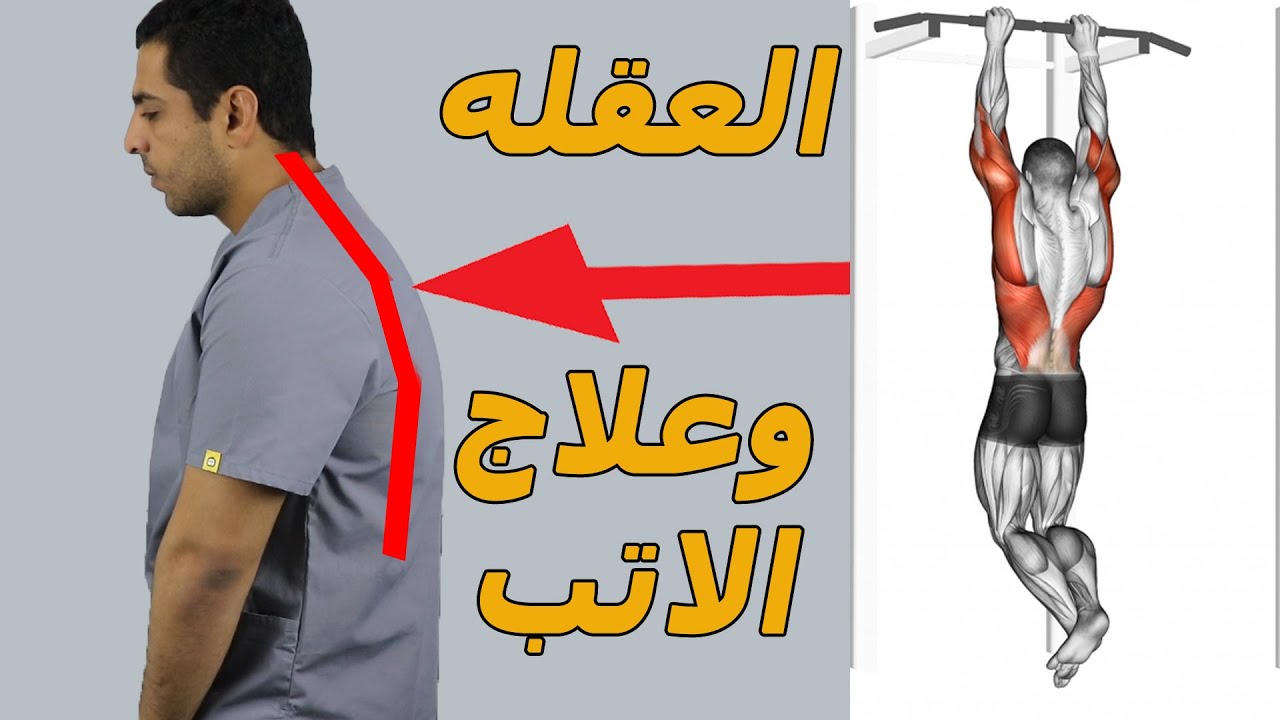 علاج تحدب الظهر(الاتب)بخطوه واحده/العقله هتخلصك من الاتب؟/الجيم بيعالج الاتب