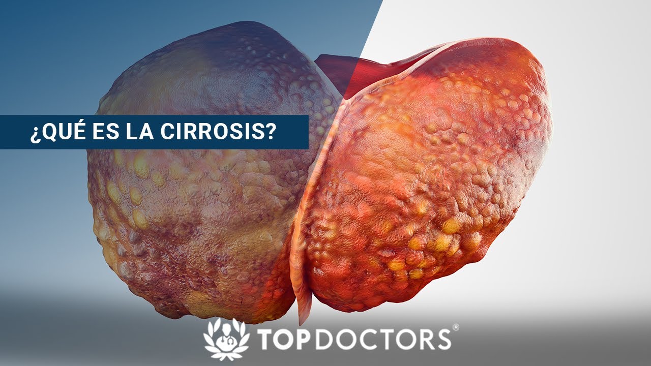 ¿Qué es la Cirrosis?