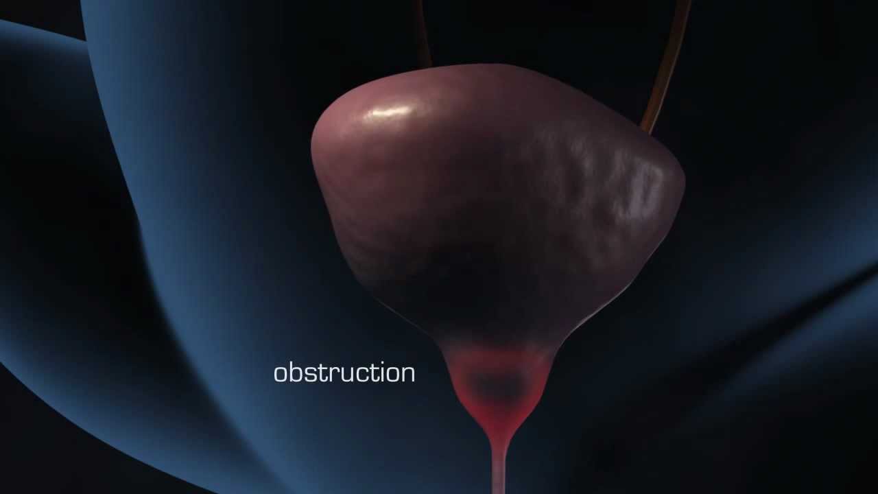 Bladder Wall Thickening