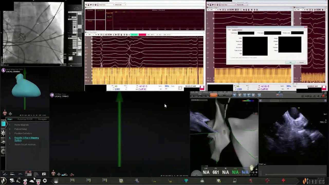 Dr. D'Souza Navigates with Robotics for Arrhythmias Originating from LV Crux (Transseptal)