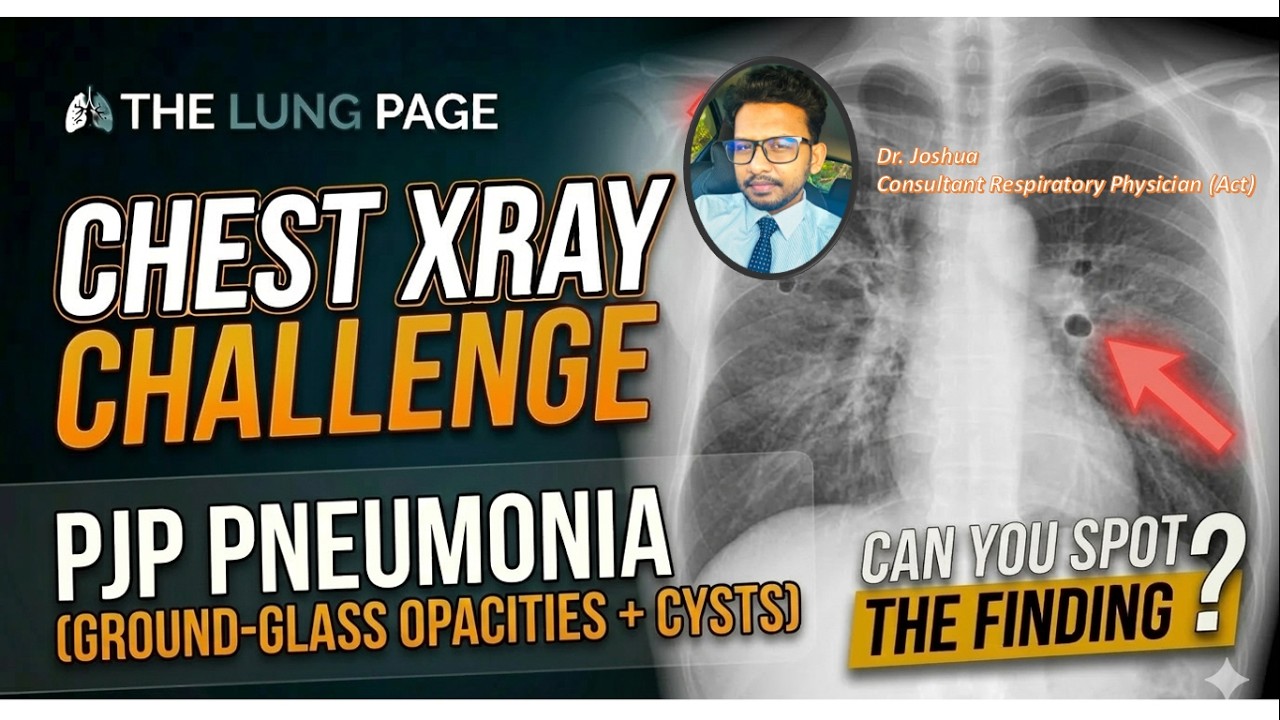 Chest x-ray challenge - 17 - PJP pneumonia