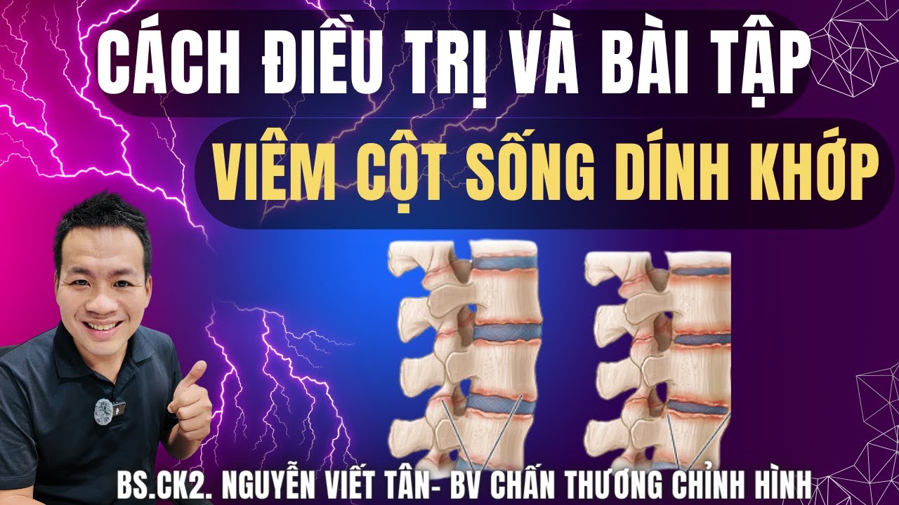 Cách điều trị và bài tập Viêm Cột Sống Dính Khớp _Khớp Việt Official