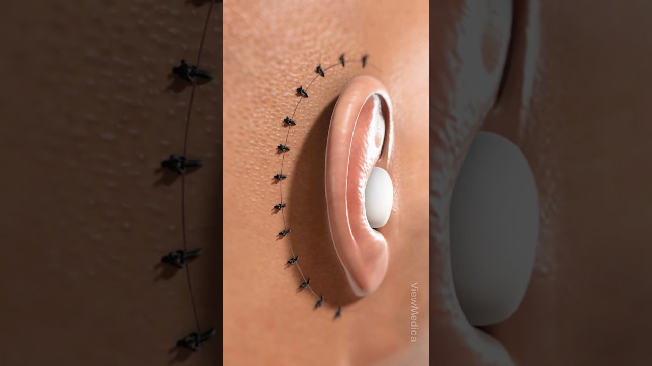 What is tympanomastoidectomy? (3D Animation)