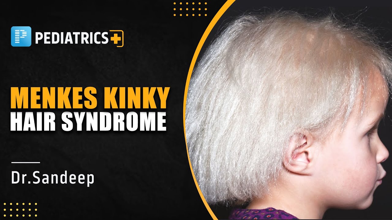 Menkes Kinky Hair Syndrome by Dr. Sandeep Sharma | PrepLadder NEET SS