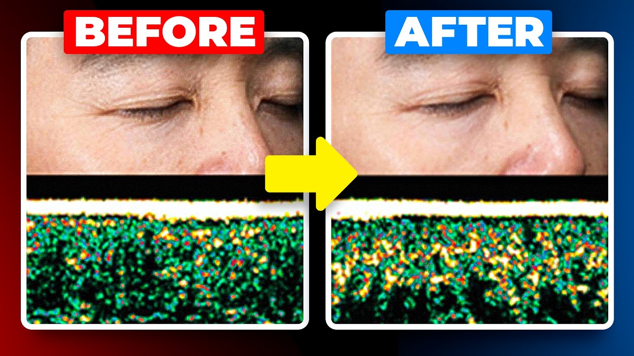 Hyaluronic Acid Reversed Wrinkles by 18% in Human Study