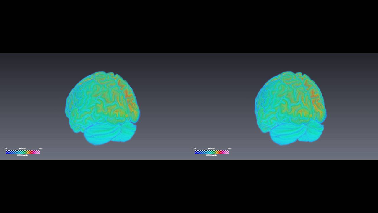 Volume Rendering and Rotation of Human Brain(3D)