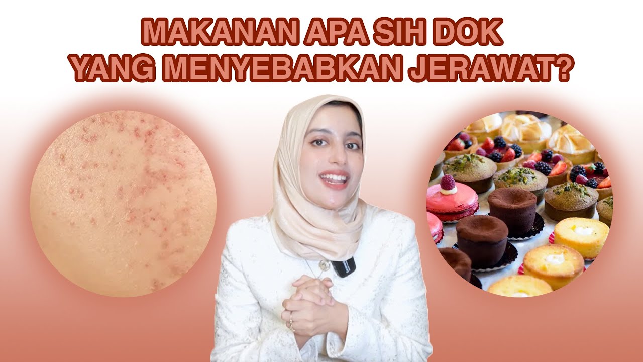 APA AJA SIH MAKANAN PENYEBAB JERAWAT?! Jangan salah, ini penyebab jerawat!