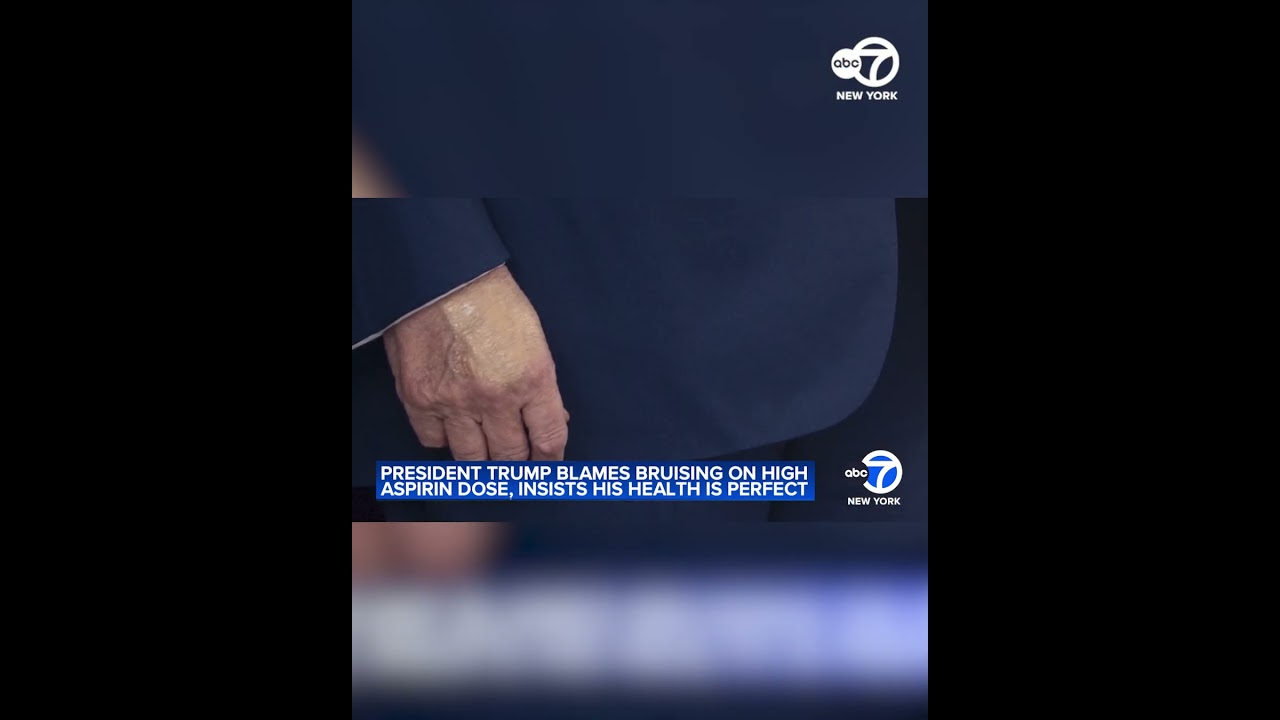 Trump blames hand bruises on high aspirin dose