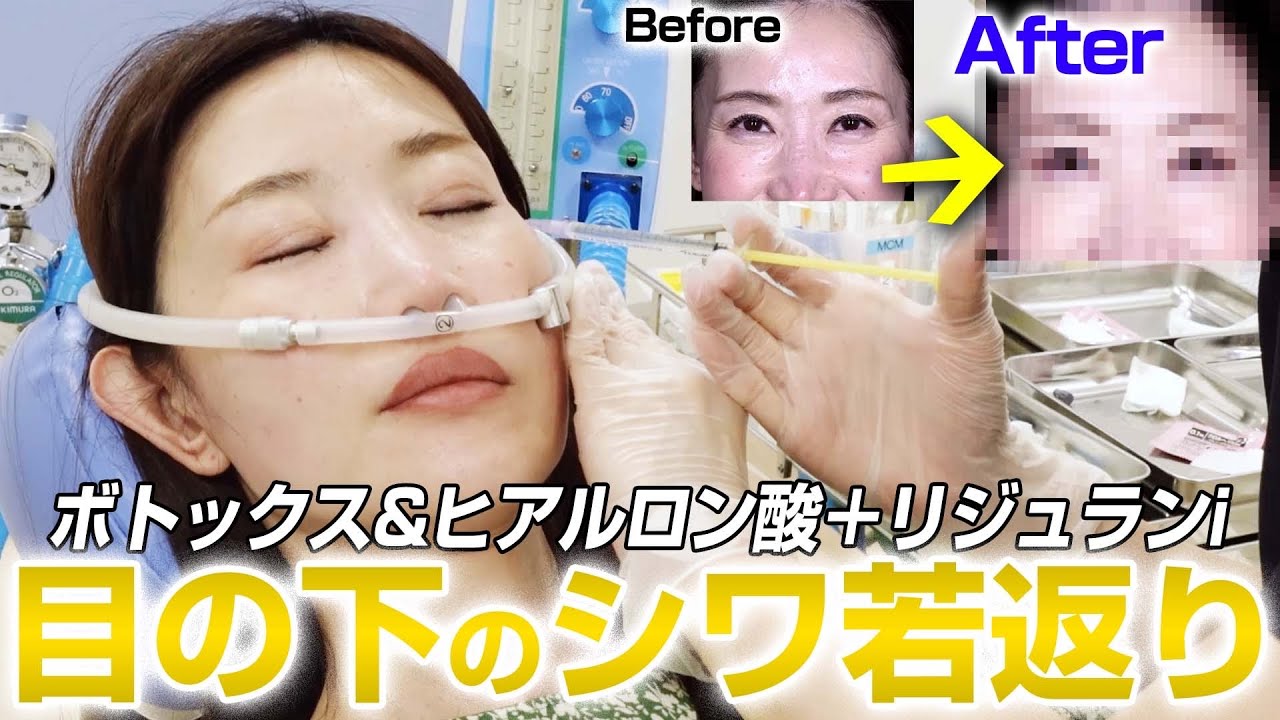 【劇的変化】目元の小ジワが気になる患者様を治療しました。