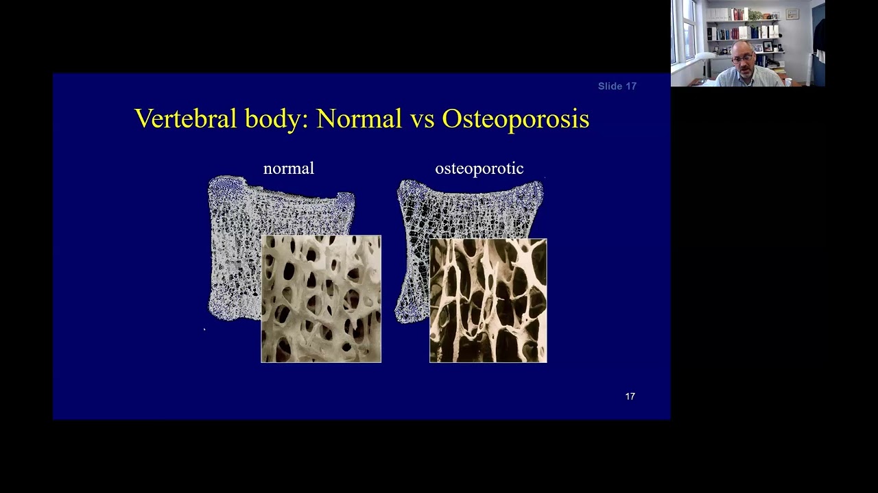 April 2024 ACC - Osteoporosis and HIV: Optimal Evaluation and Management to Prevent Fractures
