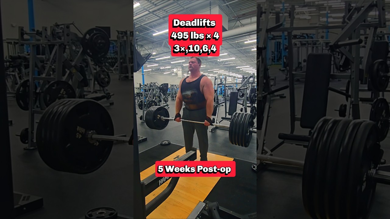 Week 20: Pull Day Exercise 1: Deadlift 5 Weeks Post-op 495 lbs × 4 3x10,6,4