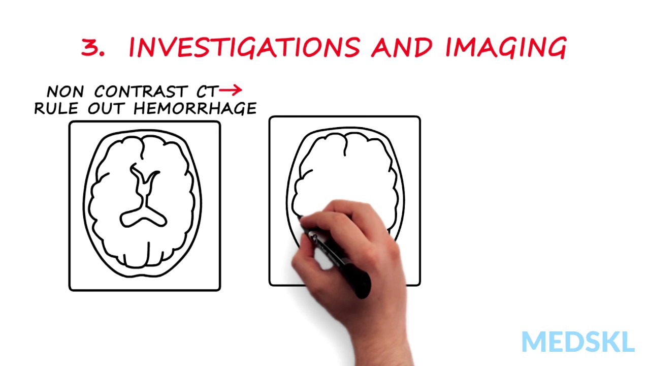 Neurology &ndash; Hemiplegia, Hemisensory Loss (With or Without Aphasia): By Ted Wein M.D.