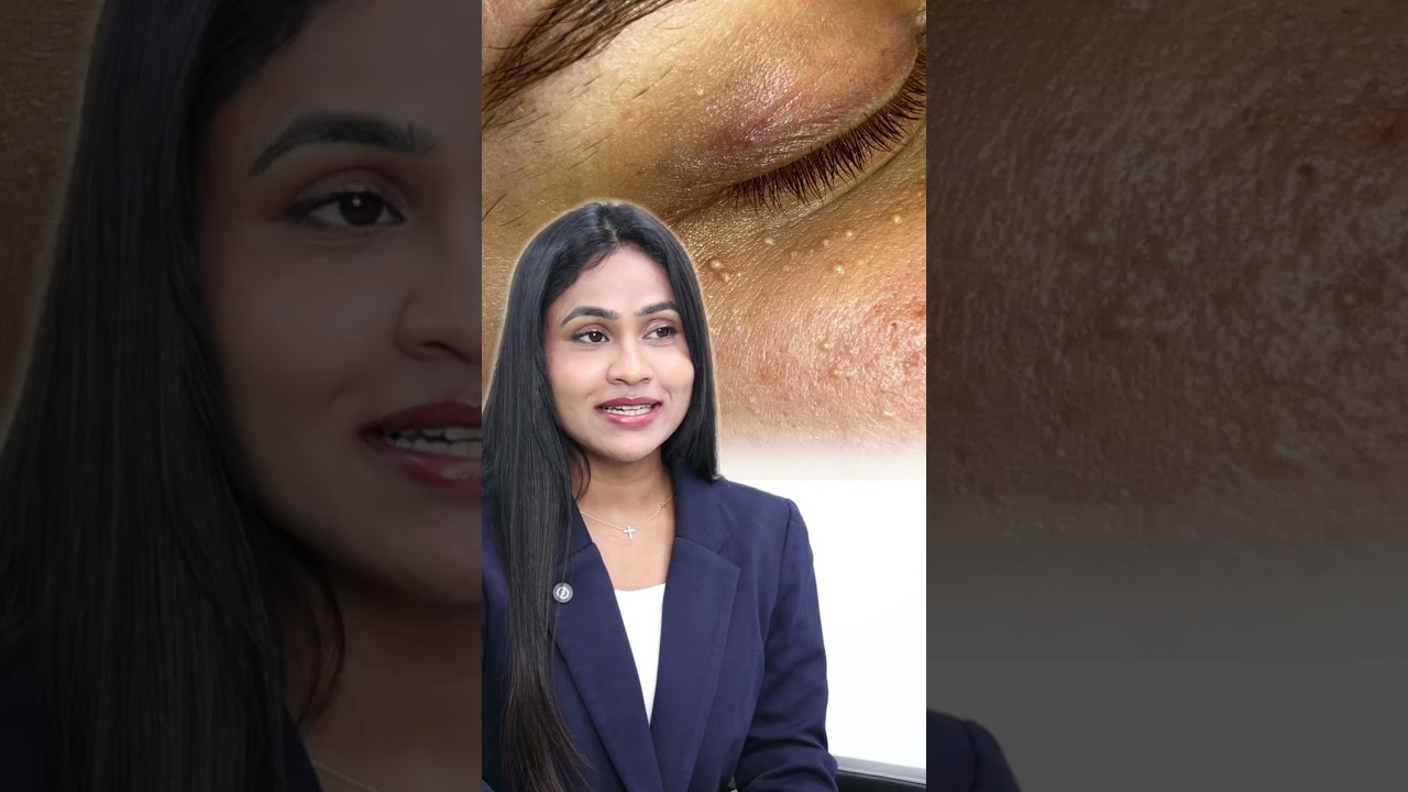 Milia Extraction: Clear, Bump-Free Skin Instantly | #vcare  Clinics
