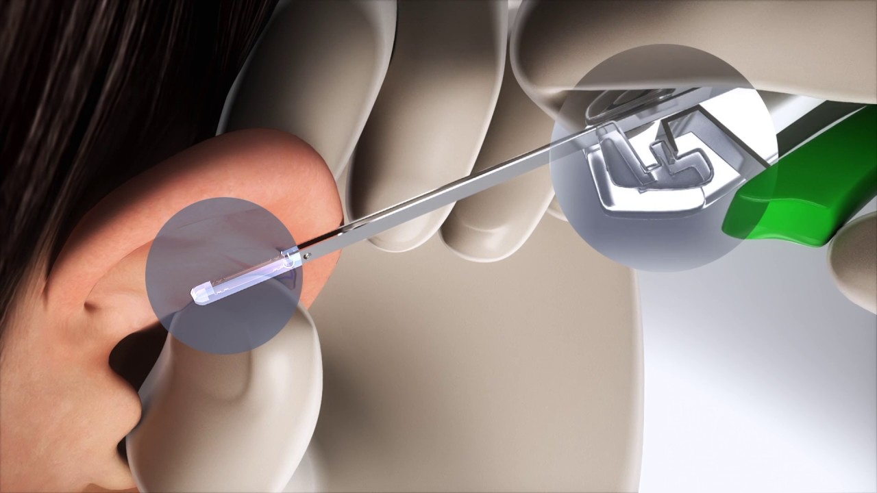 Earfold2: Medicina Estética Facial Valencia